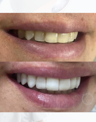 Imagem de antes e depois de um tratamento de harmonização odontológica de uma mulher