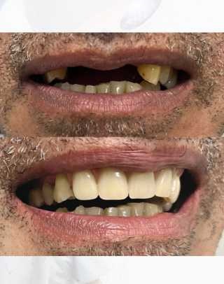 Dentista em santa Maria DF, Imagem de antes e depois de um homem com dentes quebrados e depois feita a harmonização odontológica