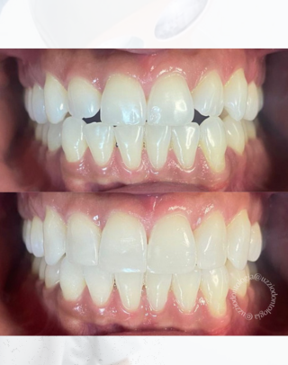 Facetas dentárias em santa Maria DF