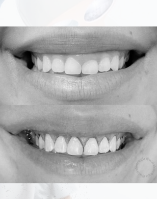 Dentista em Santa Maria, imagem mostra o antes e depois que foi feita uma cirurgia para corrigir a gengiva de uma mulher