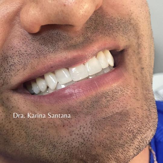 facetas em resina 3