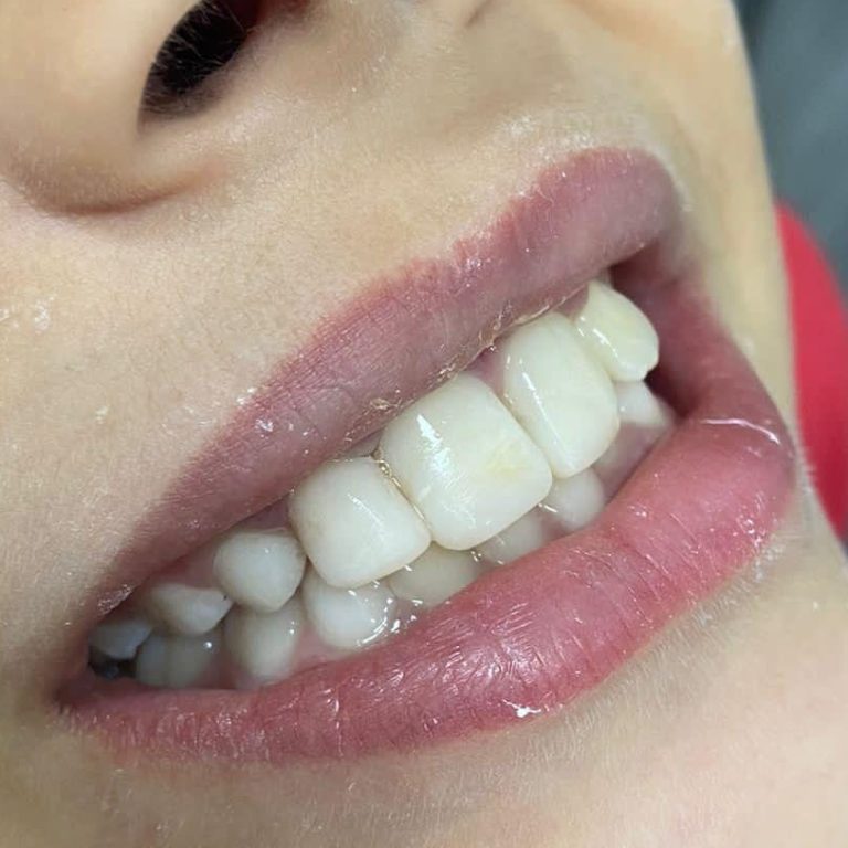 dente quebrado 1.1