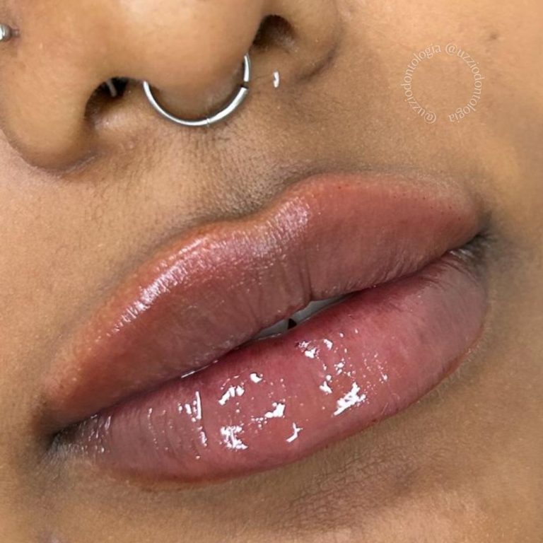 preenchimento labial 2